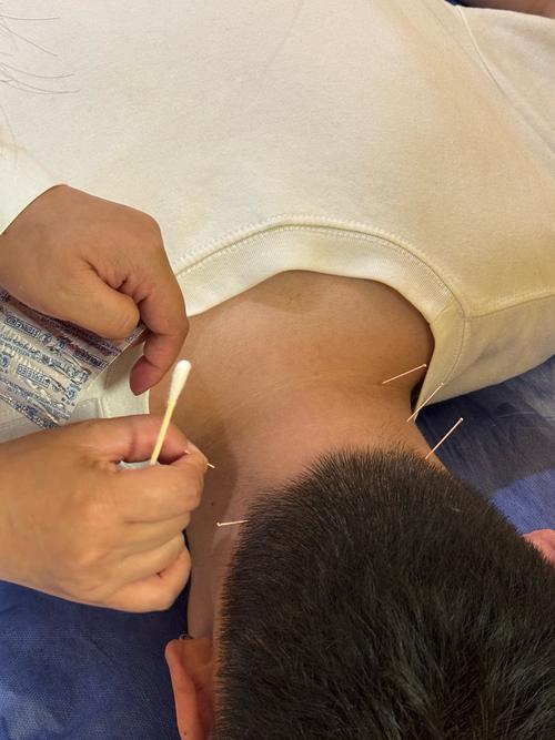 上海哪里有中医针灸