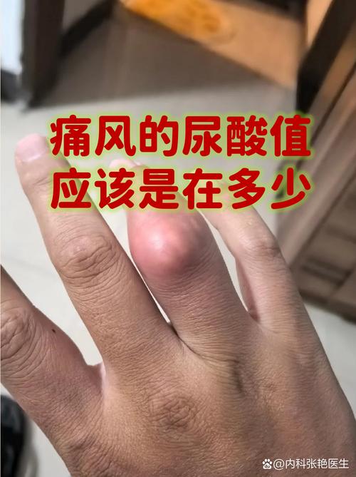 痛风病人是肾不好吗