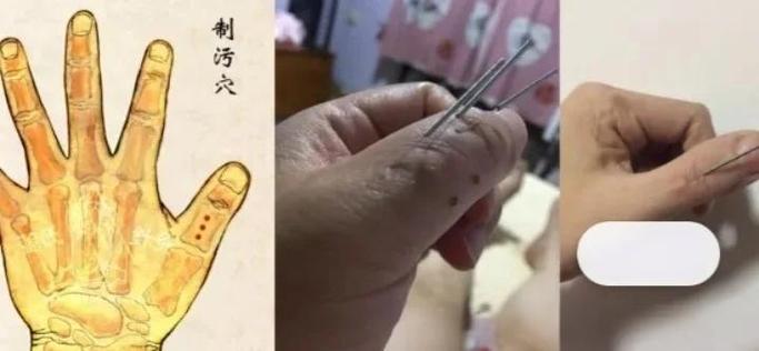 尿频尿急可以针灸吗