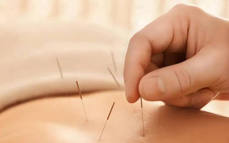 上海哪里有针灸减肥