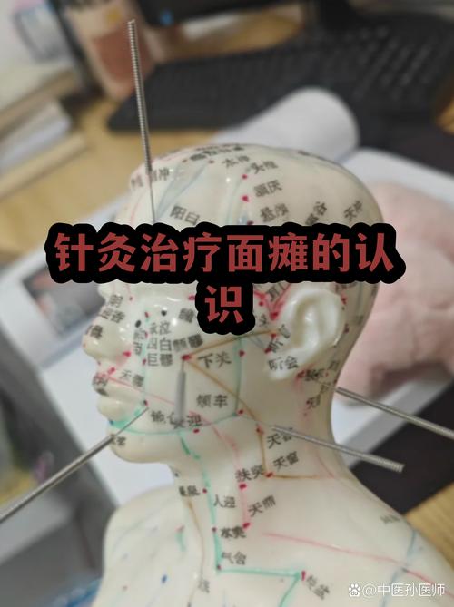 面瘫好了还用针灸吗