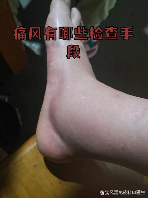 痛风病人可以开车吗