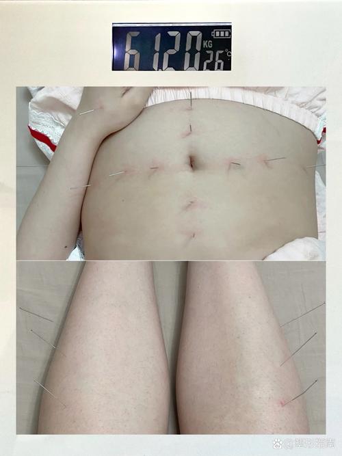 沈阳朱医生针灸减肥