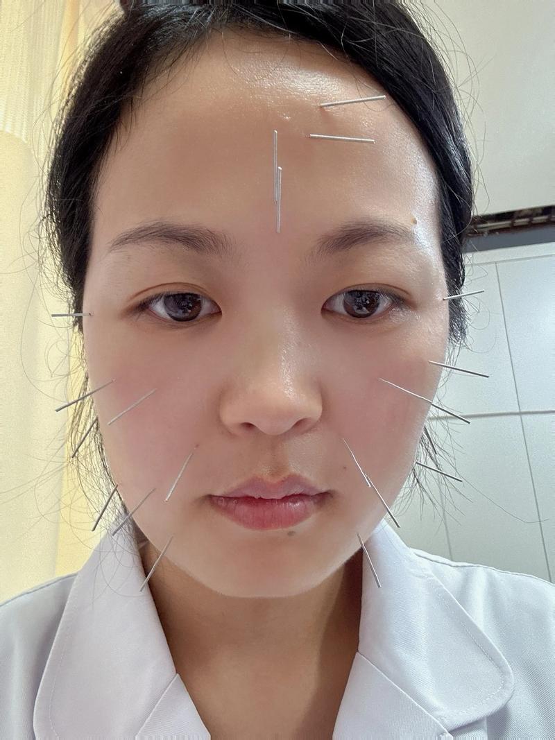 脸下垂 可以针灸吗