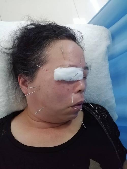 脸下垂 可以针灸吗