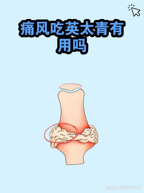 痛风吃去痛片管用吗