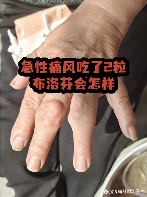 痛风药吃多久才能好