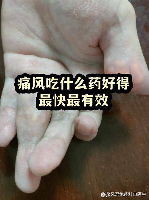 痛风药吃多久才能好