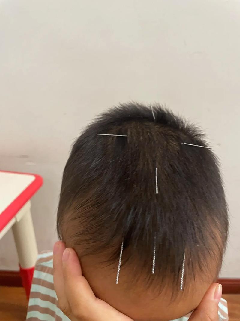 小儿针灸的最佳年龄