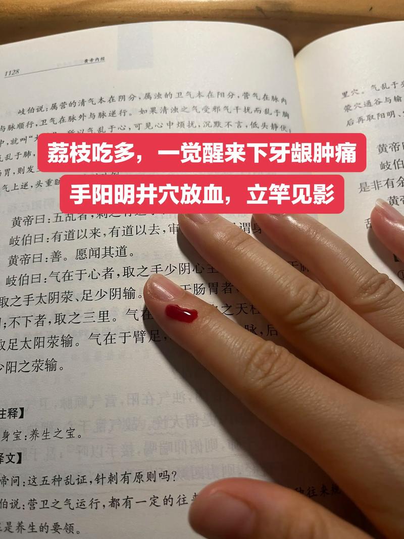 针灸放血疗法治痘痘