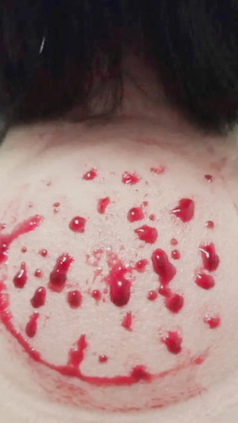 针灸放血疗法治痘痘