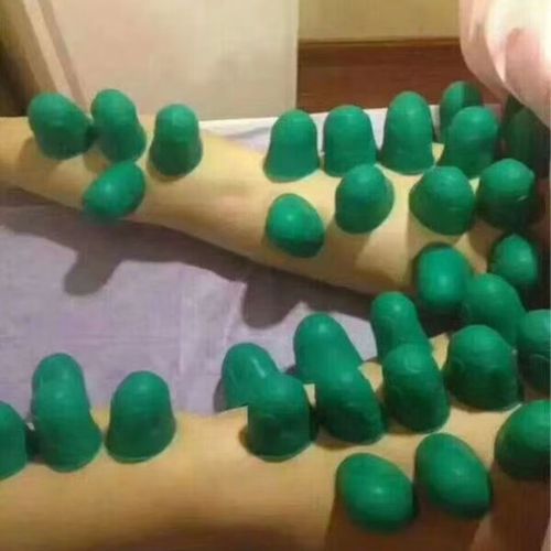 磁疗针灸器罐子价格