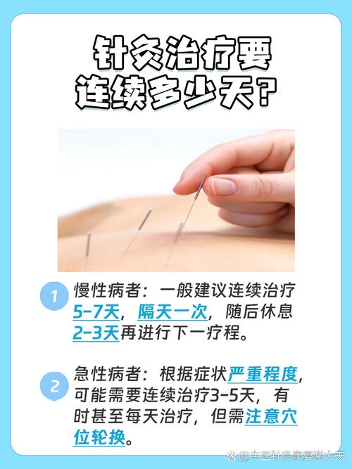 针灸可以连续扎几天