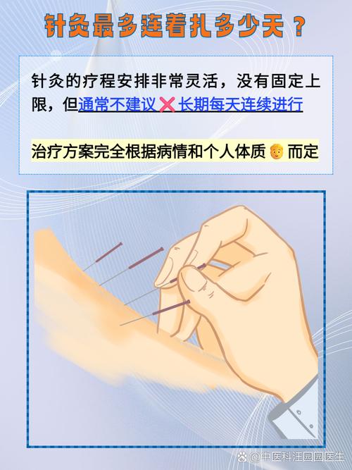 针灸可以连续扎几天