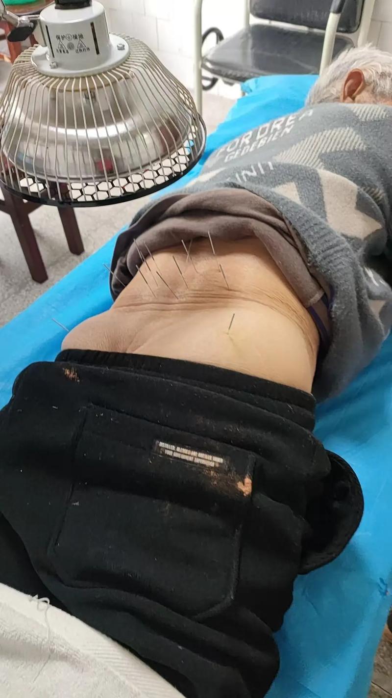 急性腰扭伤针灸案例