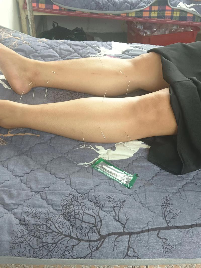 成都针灸减肥哪里好