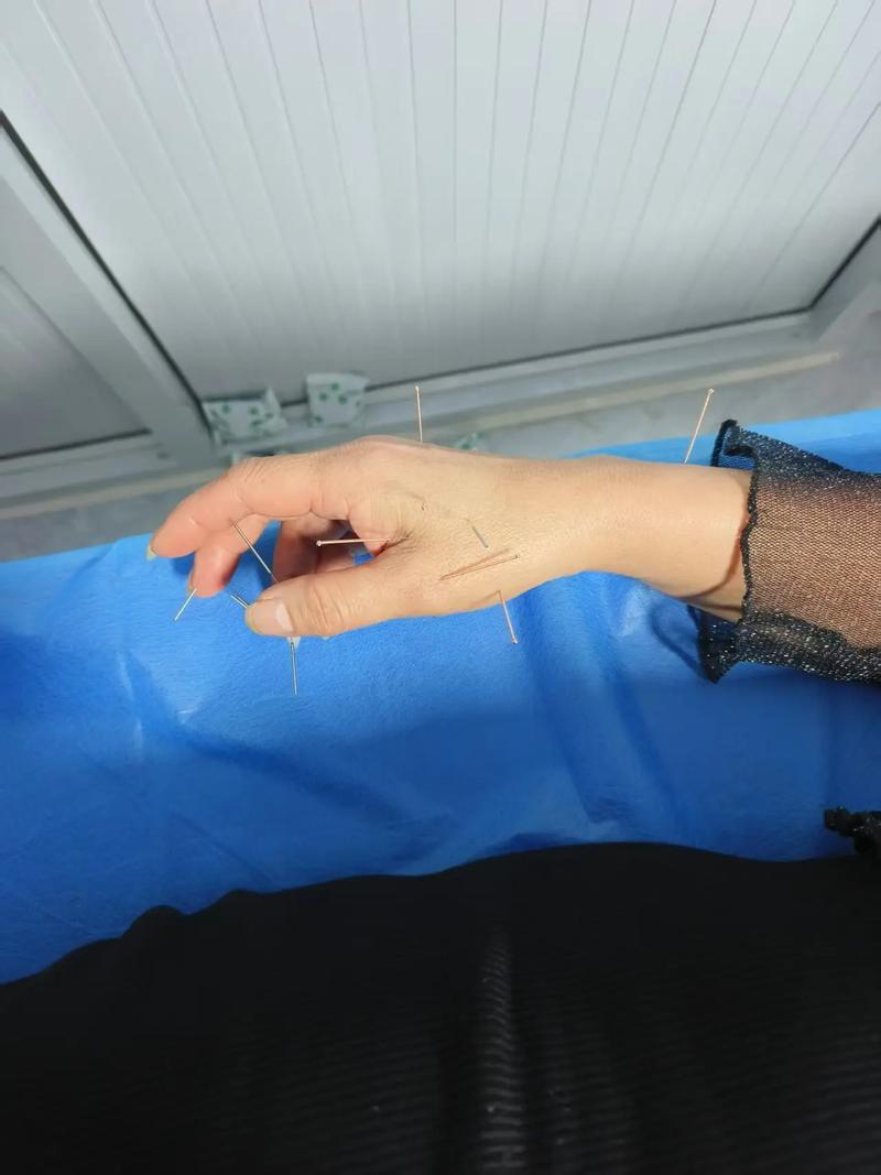 给自己针灸不敢进针