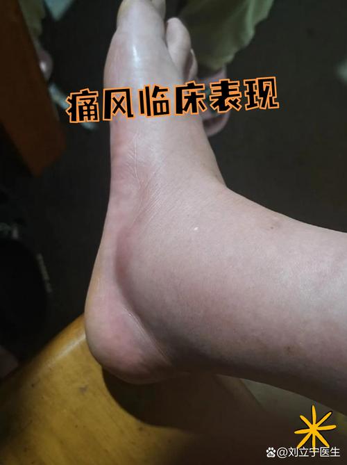 痛风需要把脚抬多高