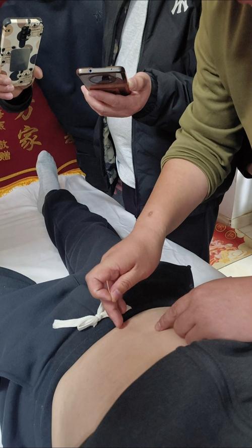 针灸治输尿管结石吗