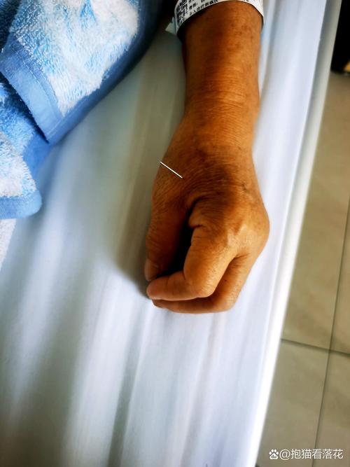 针灸治输尿管结石吗