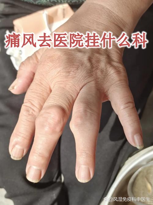 上海第六医院痛风科