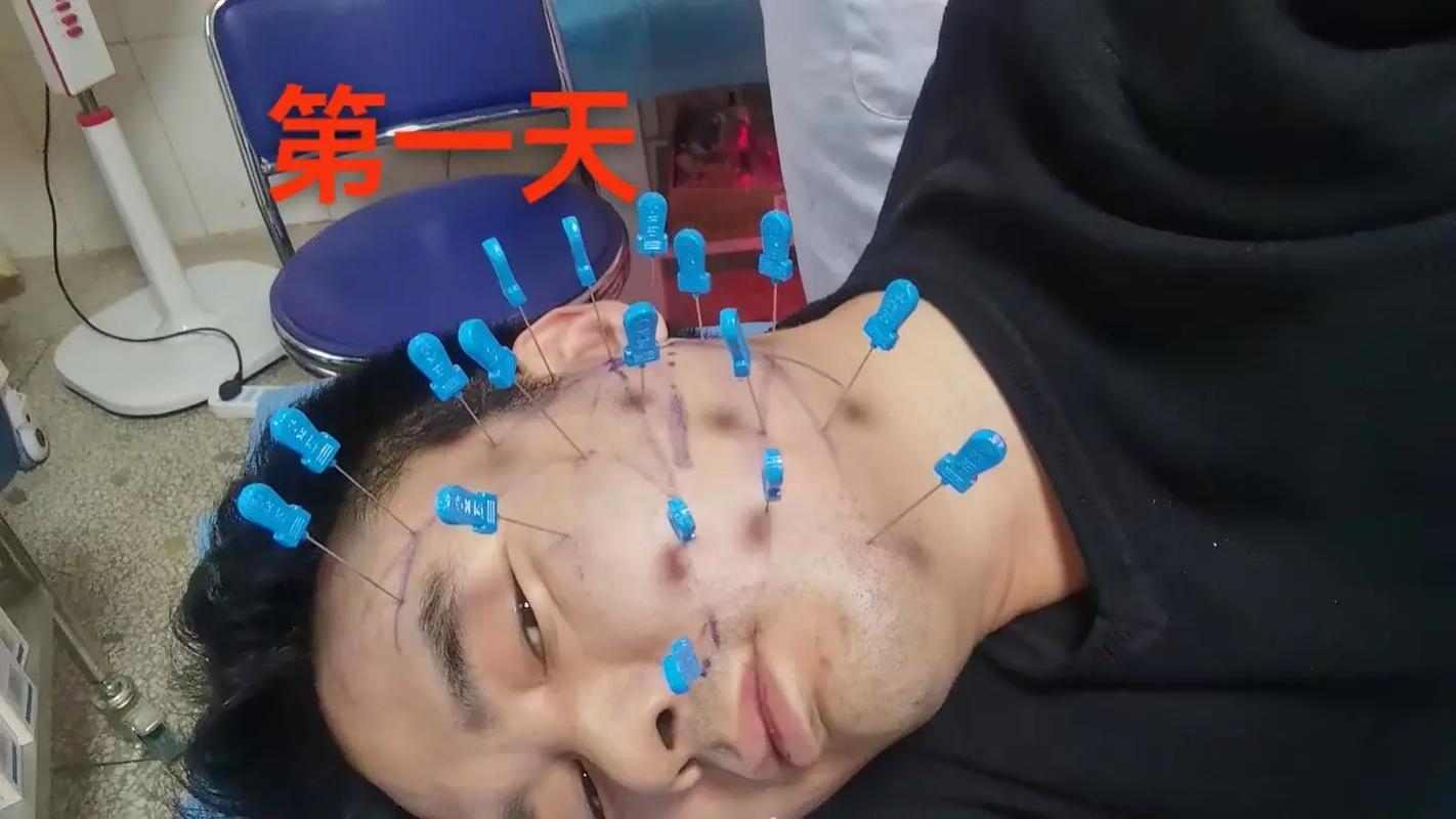 针灸治疗面瘫管用吗