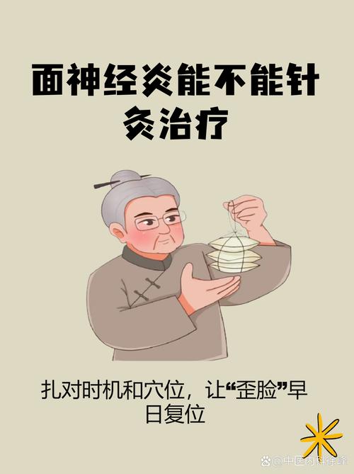 针灸治疗面瘫管用吗