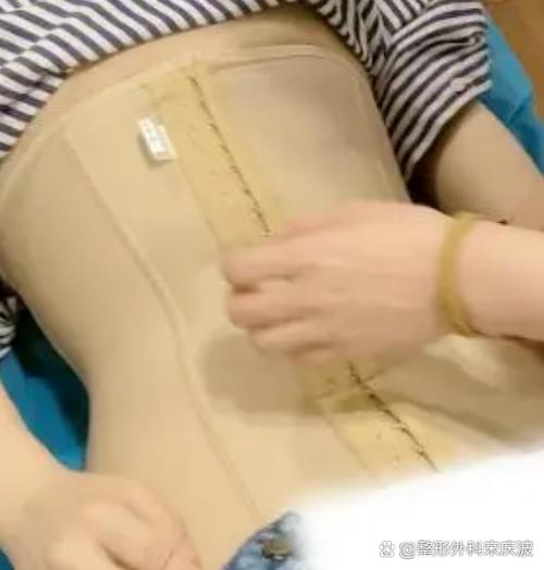 肚子吸脂肪手术安全吗